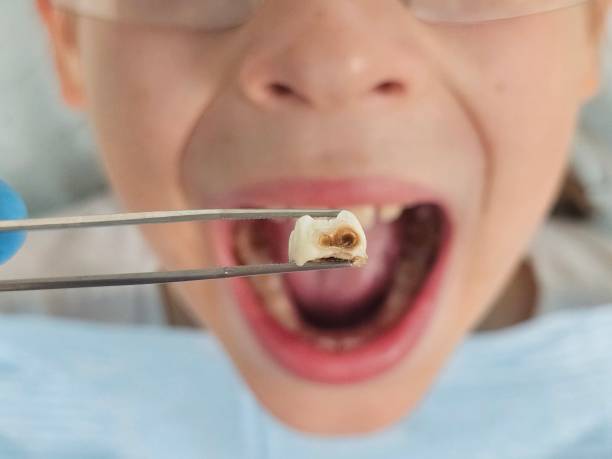 Best Emergency Dental Care for Abscessed Tooth in Riverside, IA